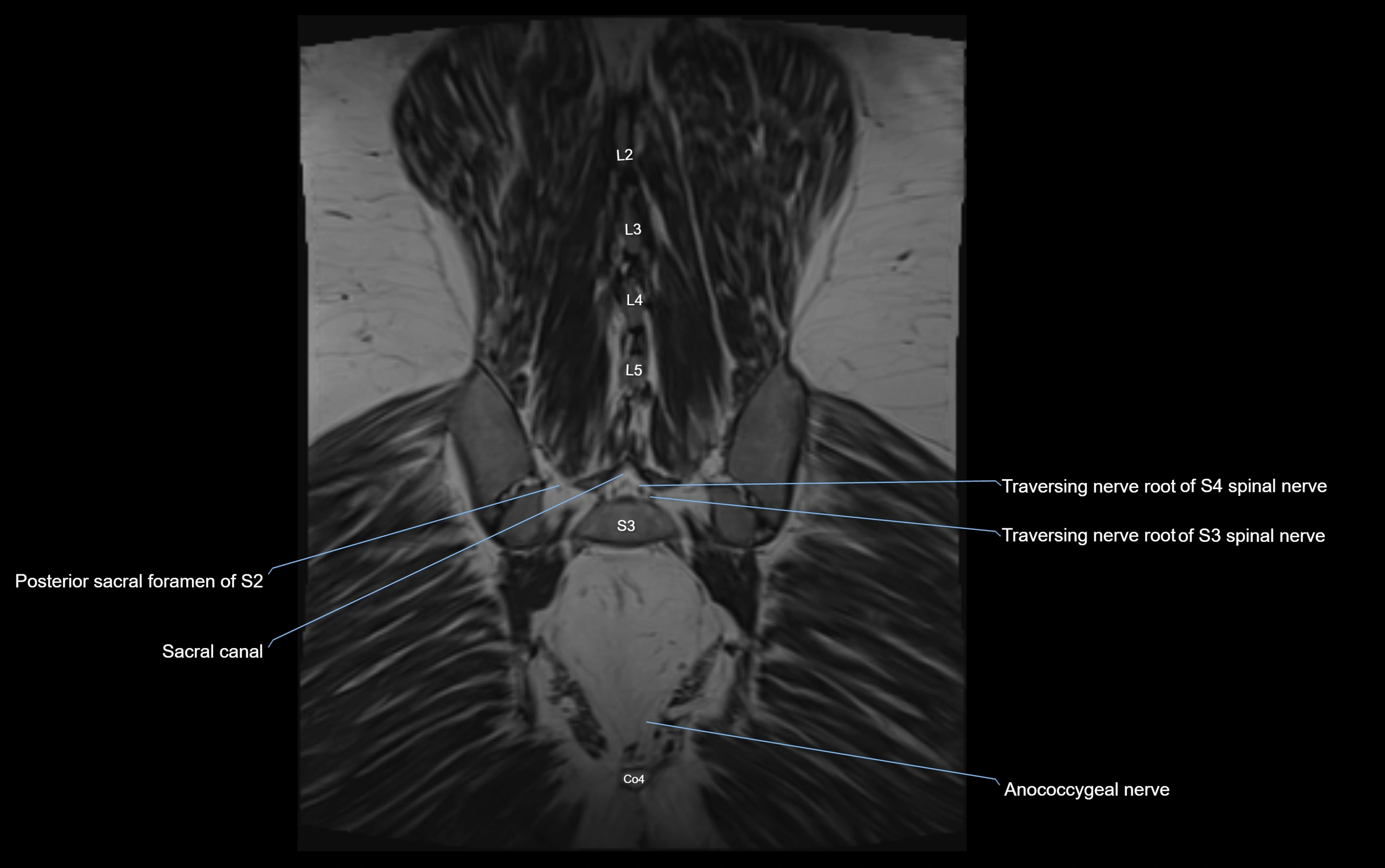 MR lumbosacral plexus cross sectional anatomy 3T  radiology  image-img-09001-00069.webp